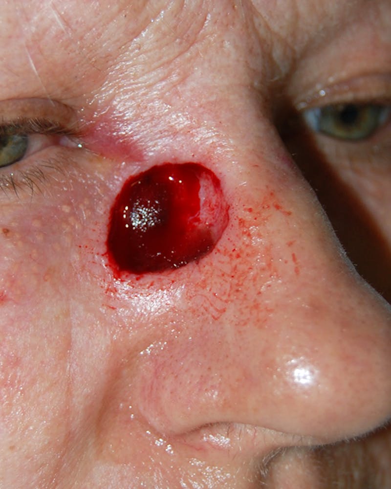 Mohs Nose Before & After Gallery - Patient 124244 - Image 1