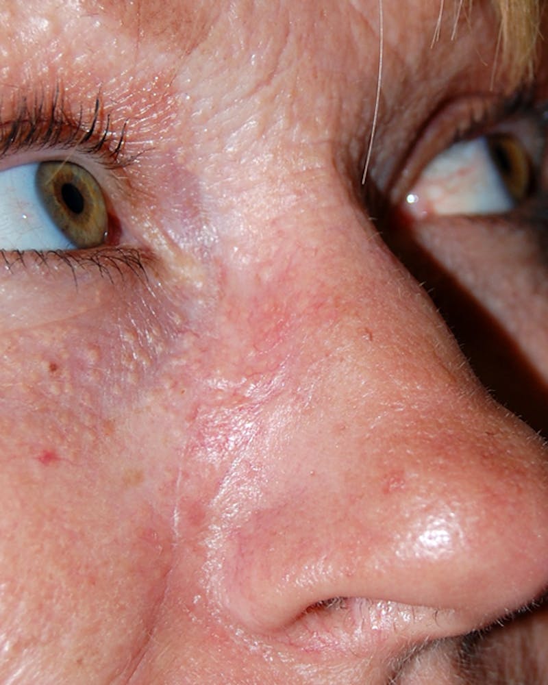 Mohs Nose Before & After Gallery - Patient 124244 - Image 2