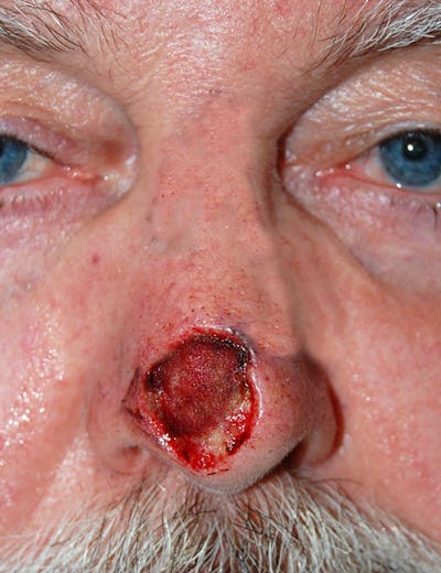 Mohs Nose Before & After Gallery - Patient 255591 - Image 1