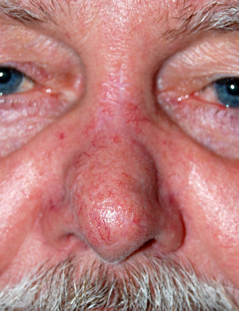 Mohs Nose Before & After Gallery - Patient 255591 - Image 2