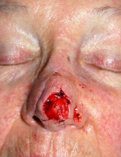 Mohs Nose Before & After Gallery - Patient 421980 - Image 1