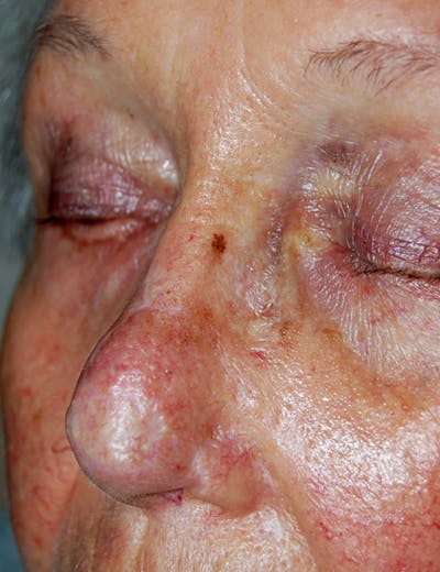 Mohs Nose Before & After Gallery - Patient 421980 - Image 2