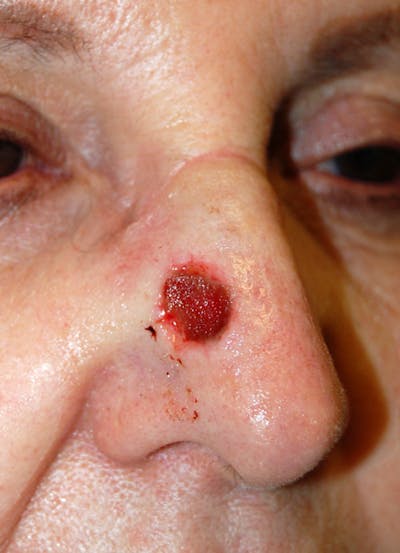 Mohs Nose Before & After Gallery - Patient 361830 - Image 1