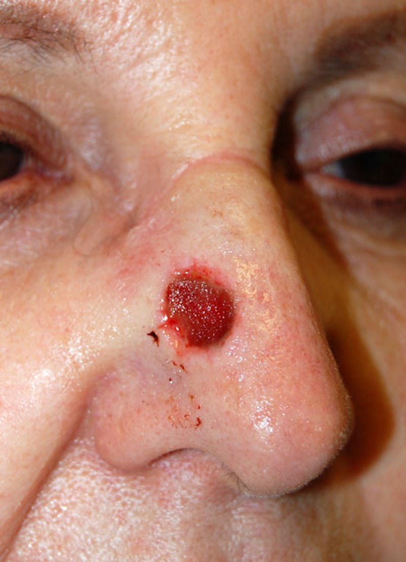 Mohs Nose Before & After Gallery - Patient 361830 - Image 1