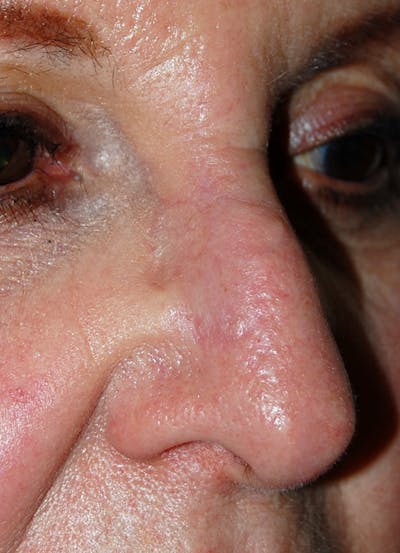 Mohs Nose Before & After Gallery - Patient 361830 - Image 2