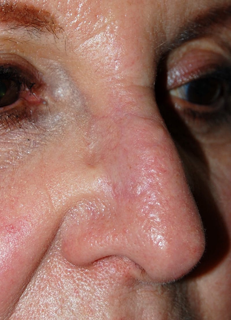 Mohs Nose Before & After Gallery - Patient 361830 - Image 2