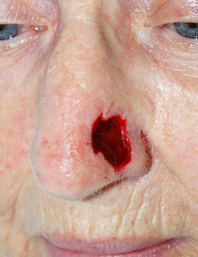 Mohs Nose Before & After Gallery - Patient 176640 - Image 1