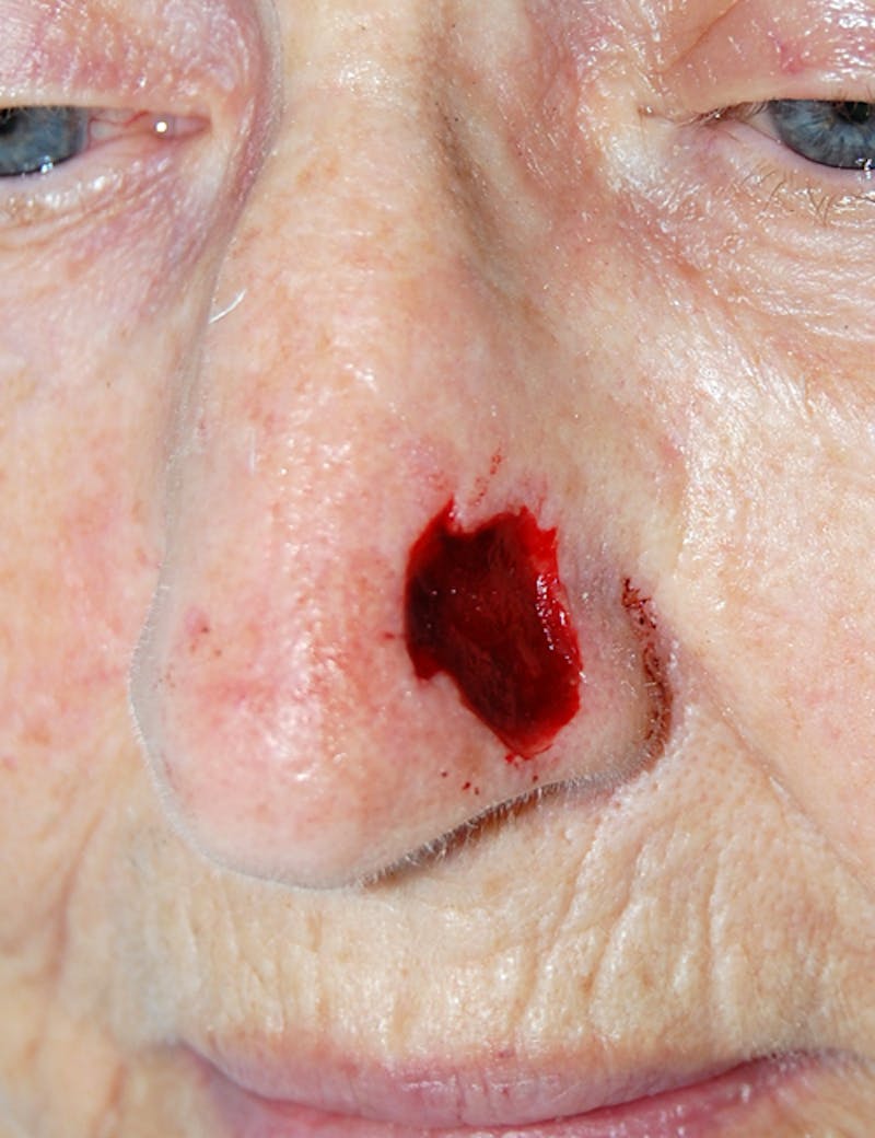 Mohs Nose Before & After Gallery - Patient 176640 - Image 1