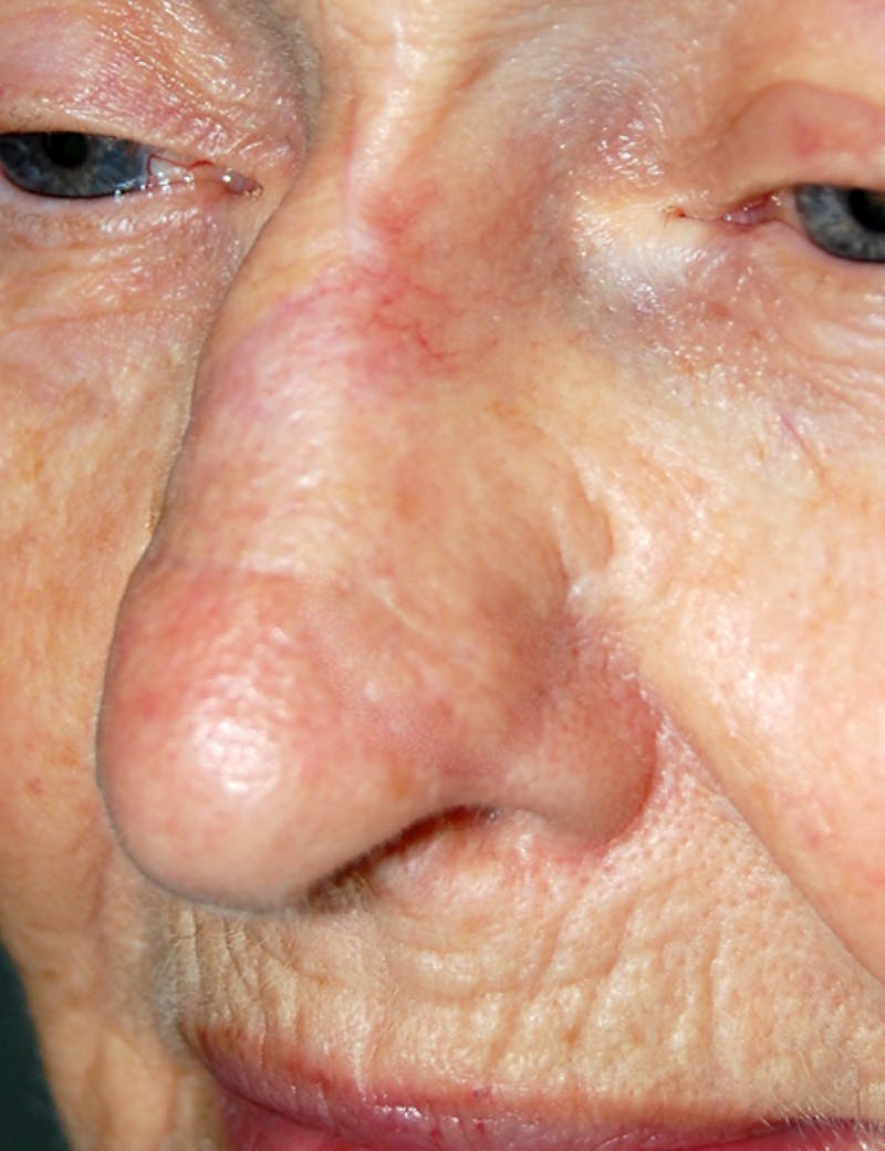 Mohs Nose Before & After Gallery - Patient 176640 - Image 2
