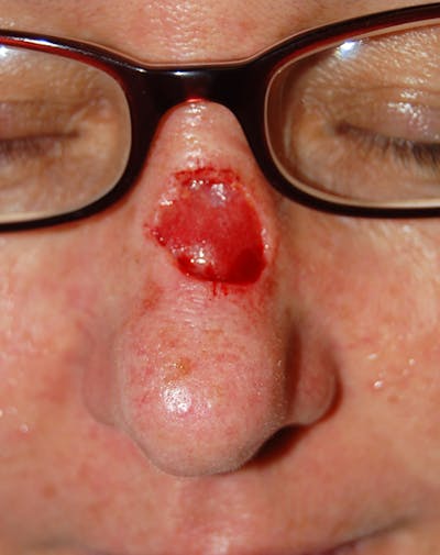 Mohs Nose Before & After Gallery - Patient 242898 - Image 1