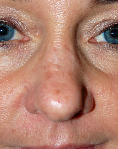 Mohs Nose Before & After Gallery - Patient 242898 - Image 2