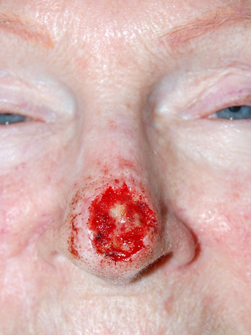 Mohs Nose Before & After Gallery - Patient 203029 - Image 1