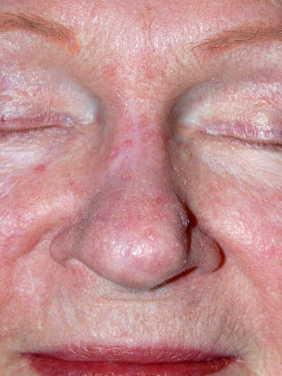 Mohs Nose Before & After Gallery - Patient 203029 - Image 2