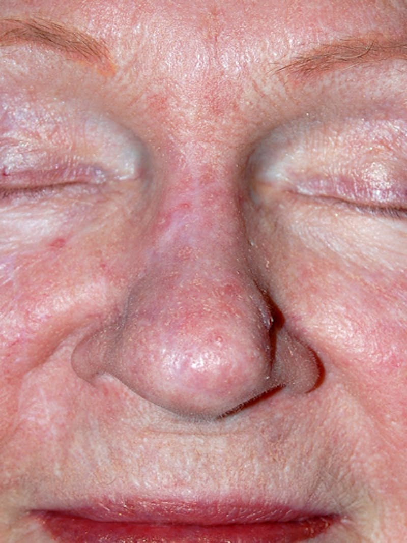 Mohs Nose Before & After Gallery - Patient 203029 - Image 2