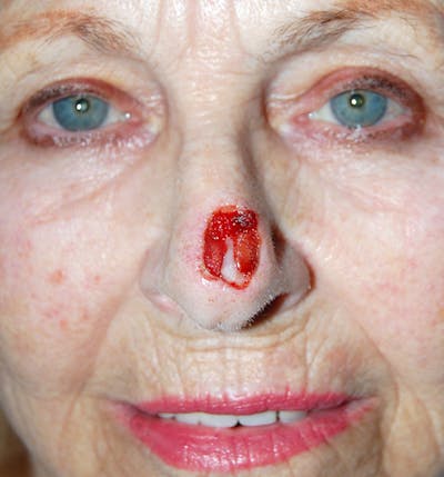 Mohs Nose Before & After Gallery - Patient 152720 - Image 1