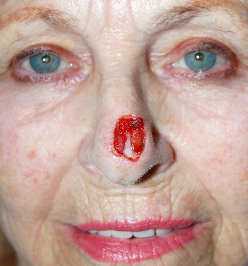 Mohs Nose Before & After Gallery - Patient 152720 - Image 1