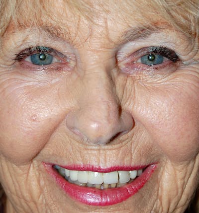 Mohs Nose Before & After Gallery - Patient 152720 - Image 2