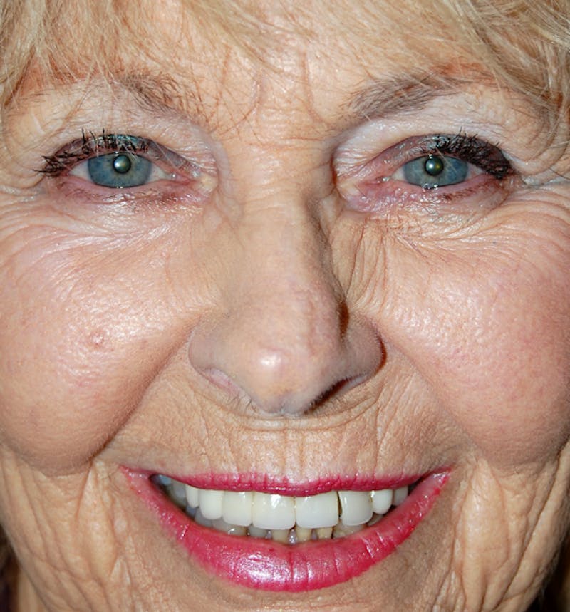 Mohs Nose Before & After Gallery - Patient 152720 - Image 2