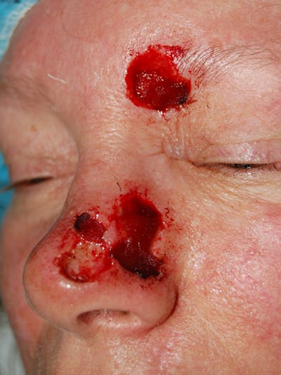 Mohs Nose Before & After Gallery - Patient 619338 - Image 1