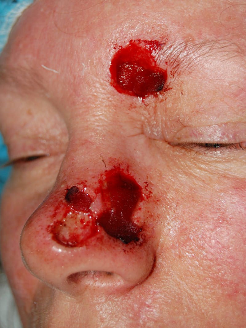 Mohs Nose Before & After Gallery - Patient 619338 - Image 1