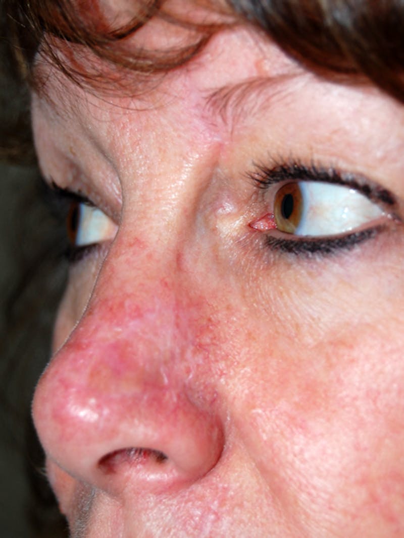 Mohs Nose Before & After Gallery - Patient 619338 - Image 2