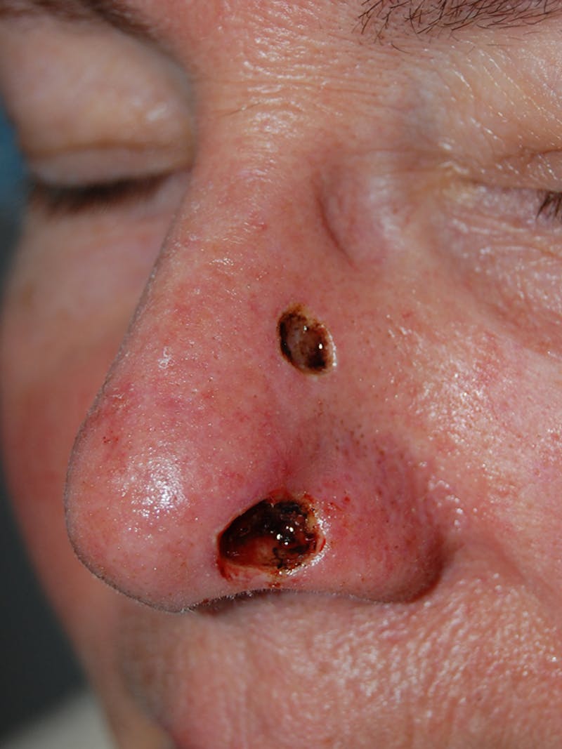 Mohs Nose Before & After Gallery - Patient 359113 - Image 1