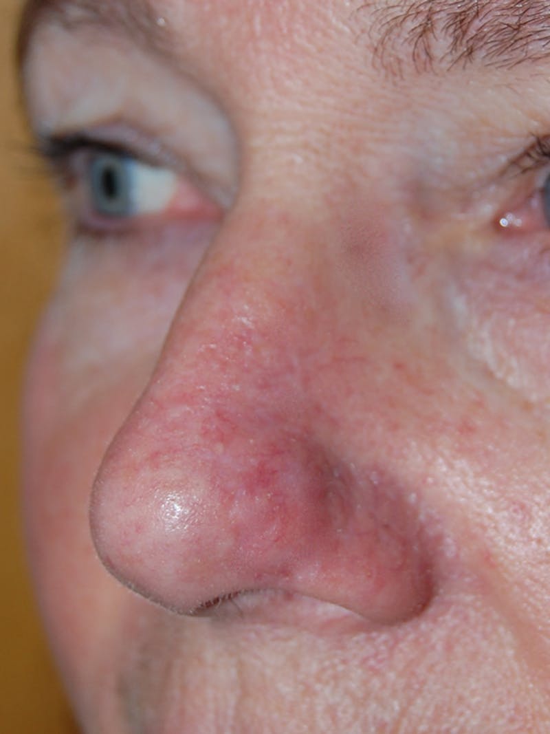 Mohs Nose Before & After Gallery - Patient 359113 - Image 2