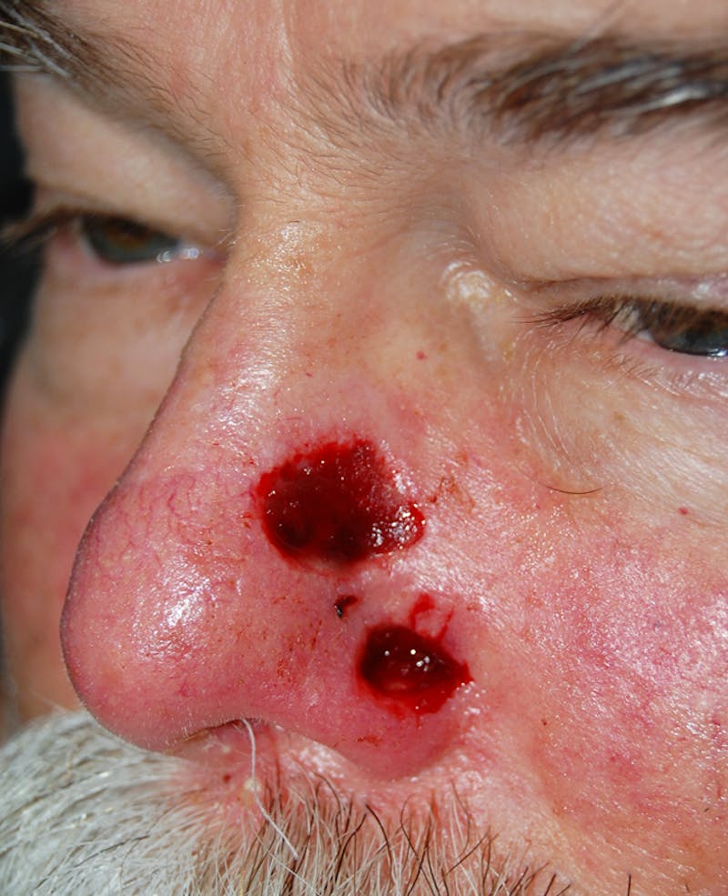 Mohs Nose Before & After Gallery - Patient 339032 - Image 1