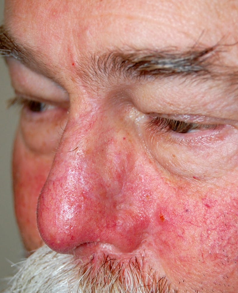 Mohs Nose Before & After Gallery - Patient 339032 - Image 2