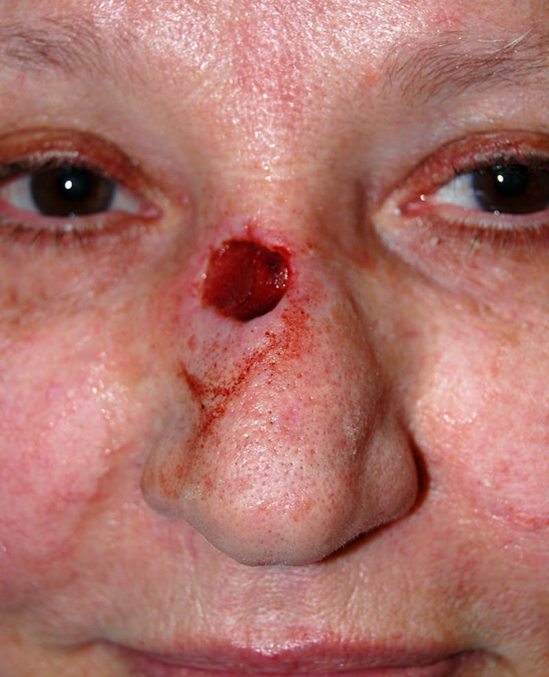 Mohs Nose Before & After Gallery - Patient 254355 - Image 1