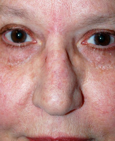 Mohs Nose Before & After Gallery - Patient 254355 - Image 2