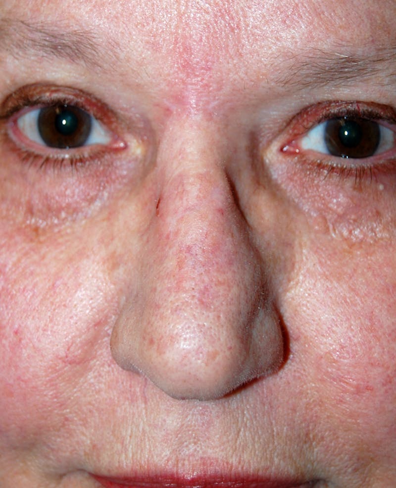 Mohs Nose Before & After Gallery - Patient 254355 - Image 2