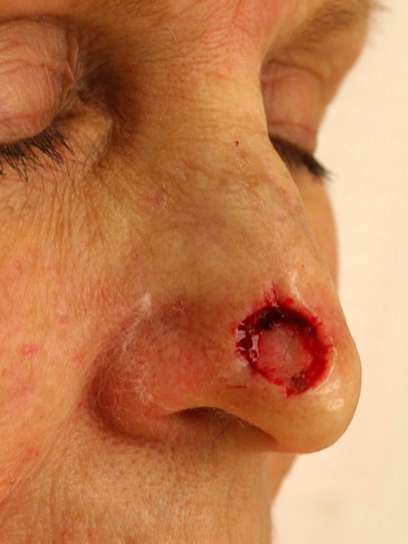 Mohs Nose Before & After Gallery - Patient 539197 - Image 1