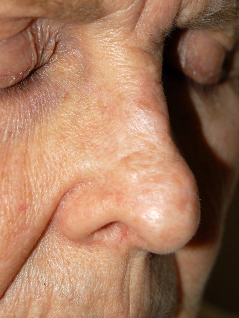 Mohs Nose Before & After Gallery - Patient 539197 - Image 2