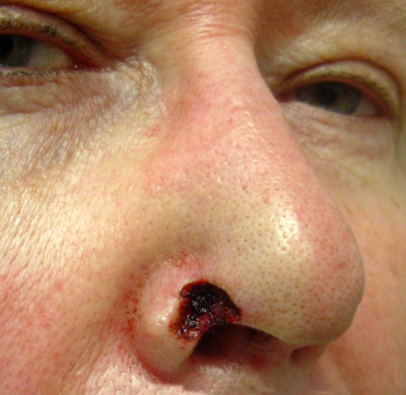 Mohs Nose Before & After Gallery - Patient 171117 - Image 1