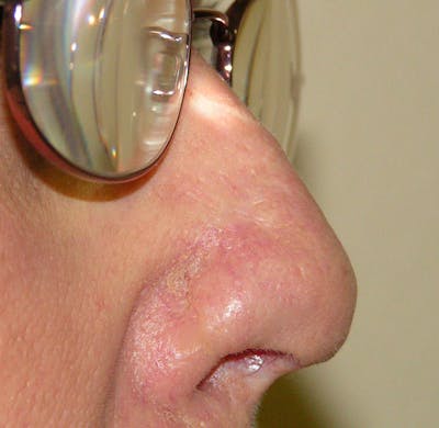 Mohs Nose Before & After Gallery - Patient 171117 - Image 2