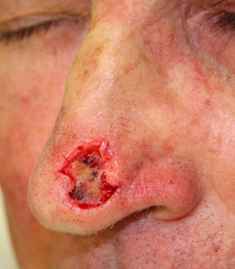 Mohs Nose Before & After Gallery - Patient 302290 - Image 1