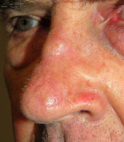 Mohs Nose Before & After Gallery - Patient 302290 - Image 2