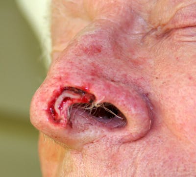 Mohs Nose Before & After Gallery - Patient 323285 - Image 1