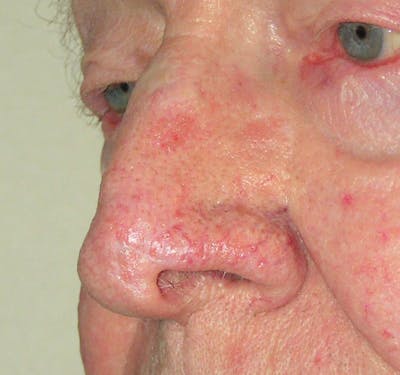 Mohs Nose Before & After Gallery - Patient 323285 - Image 2