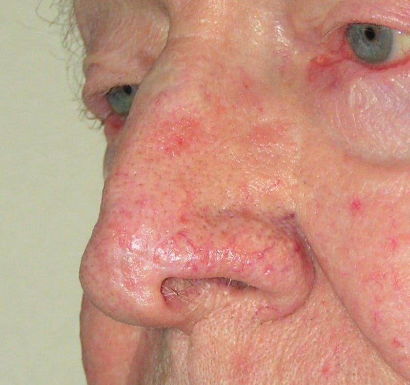 Mohs Nose Before & After Gallery - Patient 323285 - Image 2