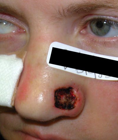 Mohs Nose Before & After Gallery - Patient 174208 - Image 1