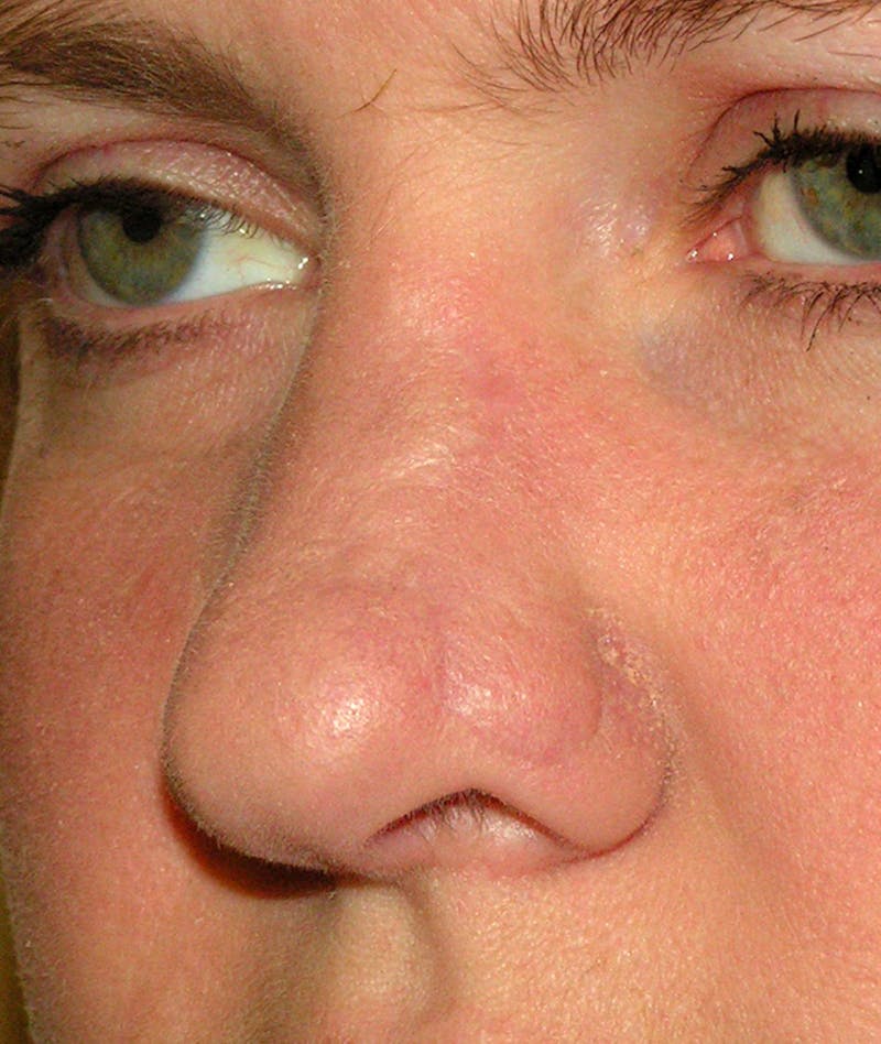 Mohs Nose Before & After Gallery - Patient 174208 - Image 2