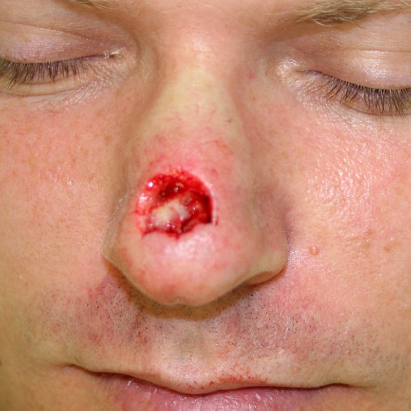 Mohs Nose Before & After Gallery - Patient 107970 - Image 1