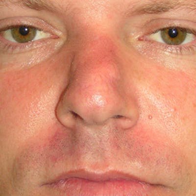 Mohs Nose Before & After Gallery - Patient 107970 - Image 2