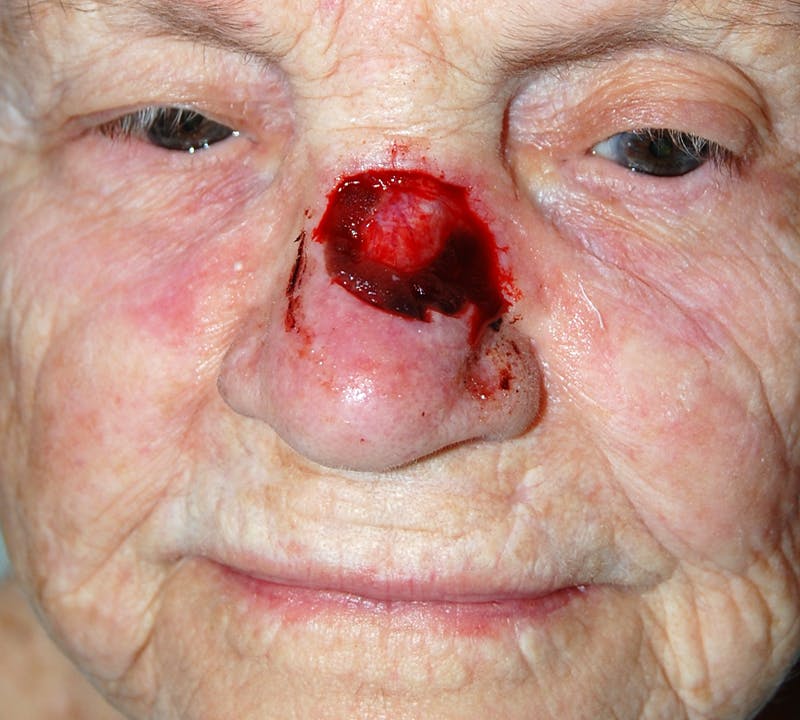 Mohs Nose Before & After Gallery - Patient 348034 - Image 1