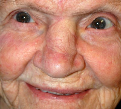 Mohs Nose Before & After Gallery - Patient 348034 - Image 2