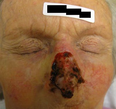 Mohs Nose Before & After Gallery - Patient 372745 - Image 1
