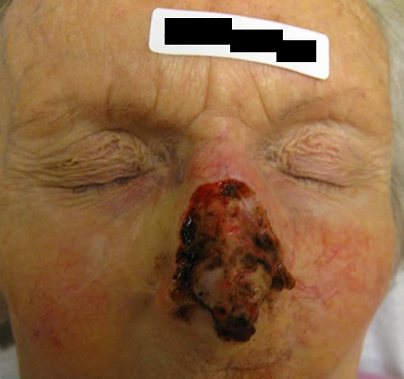 Mohs Nose Before & After Gallery - Patient 372745 - Image 1