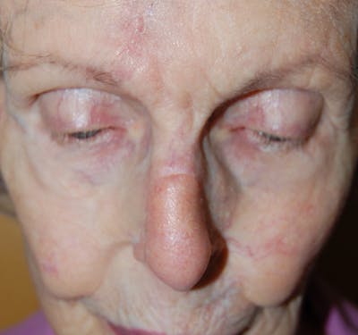 Mohs Nose Before & After Gallery - Patient 372745 - Image 2
